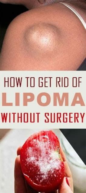 How to Get Rid of Lipoma without Surgery using Natural Home Remedies ...