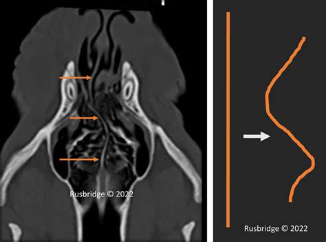 Nasal Septum Deviation – Cavalier Matters