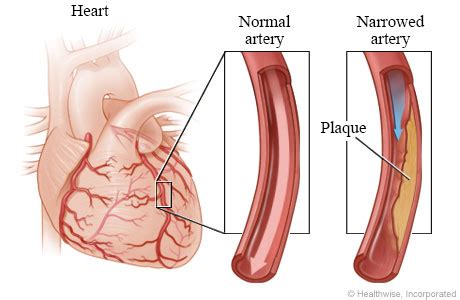 Chronic Total Occlusion | Hartford HealthCare | CT