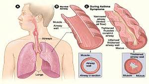 What Is Albuterol? - Uses & Side Effects | Study.com