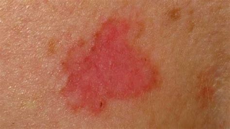 Basal Cell Carcinoma: Symptoms, Causes, and Treatment