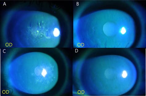 Figure 1 from Bilateral Thygeson’s Superficial Punctate Keratitis with ...