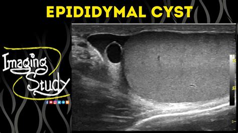 Epididymal Cyst || Ultrasound || Case 51 - YouTube