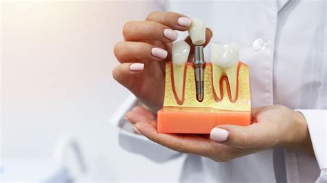 How to Care For Dental Implants: 7 Tips for Looking After Implants