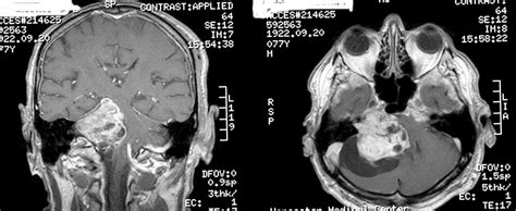 Schwannoma - Causes, Symptoms, Diagnosis. Treatment