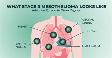 Understanding Mesothelioma Fluid in Abdomen: Causes, Symptoms, and ...