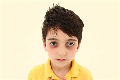 Come sbarazzarsi di occhiaie sotto gli occhi nei bambini? | Be Able