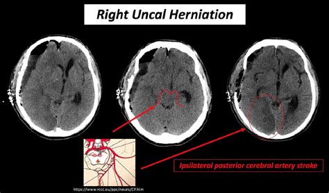 Figure 2 from Understanding Brain Herniations | Semantic Scholar