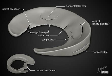 Meniscal tear | Radiology Reference Article | Radiopaedia.org