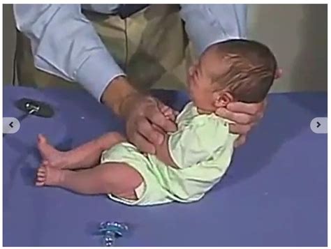 Moro Reflex | Moro reflex, Primitive reflexes, Medical