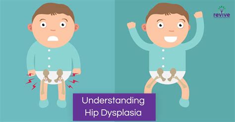 Hip Dysplasia