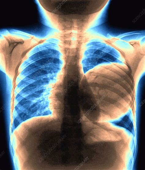 Cyst in a lung, chest X-ray - Stock Image - M170/0283 - Science Photo Library