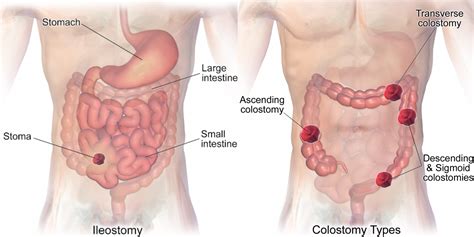 21.7 Managing Ostomies – Nursing Skills – 2e