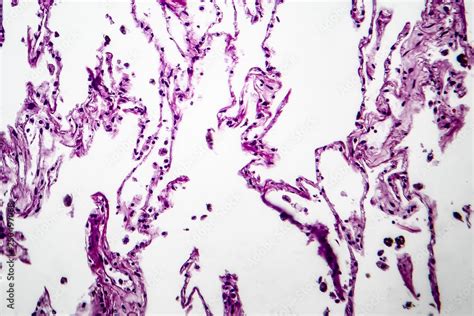 Emphysema Histology Labeled