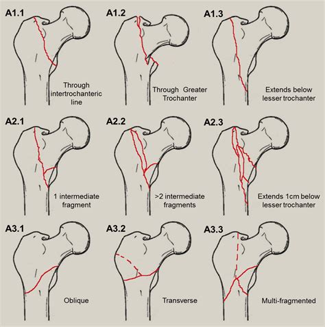 The management of intertrochanteric hip fractures - Orthopaedics and Trauma