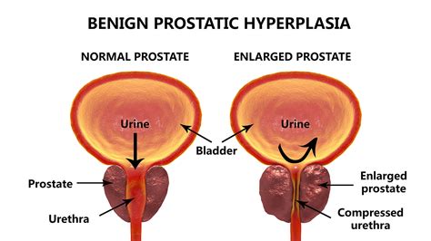 Enlarged Prostate | Benign Prostatic Hyperplasia - AVA Vascular ...