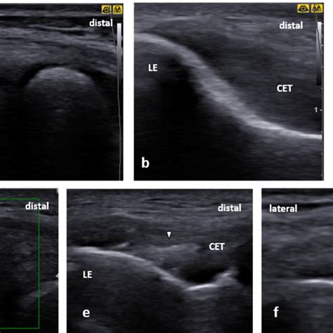 Common origin of flexors from the medial epicondyle. (a) Common flexor... | Download Scientific ...