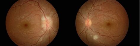 Non Arteritic Ischemic Optic Neuropathy (NAION)