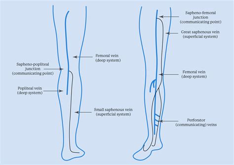 A Diagram of Leg Veins: Leg Vein Anatomy | Legacy Vein Clinic