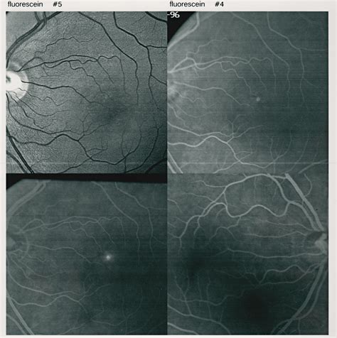 Flourescein Angiogram | Eye Patient