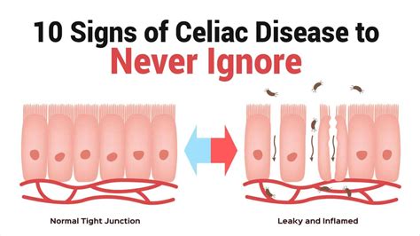 Celiac Disease Symptoms Rash