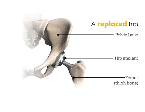 Beaumont Health | Mako Robotic-Arm Assisted Technology for total hip replacement