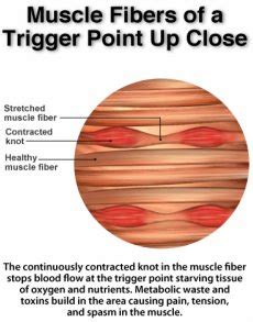 What are "knots" in muscles? And how do you get rid of them? — Outline Health | Osteopath ...