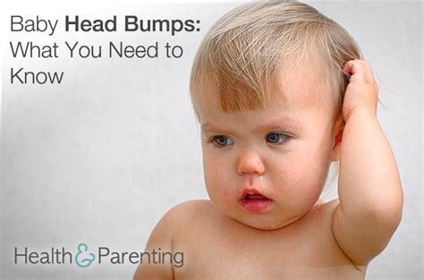 Baby Head Bumps: What You Need to Know | Head bump, Baby bumped head, Baby head