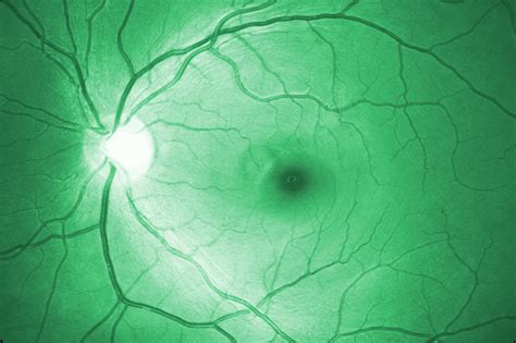 Nerve Fiber Layer Defects Imaging in Glaucoma | IntechOpen