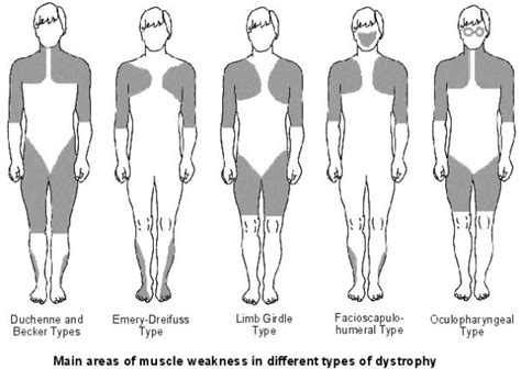 Muscular Dystrophy - Physioline