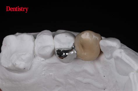 Prosthodontips – resin-retained bridges: fun and predictable - Dentistry