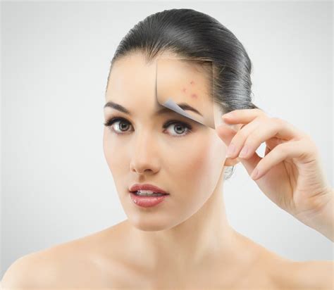 Not Just for Pimples: Why IPL Acne Treatments Can Help With Old Scars