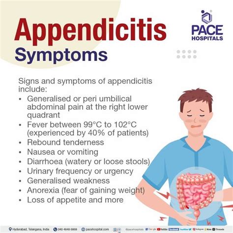 Appendicitis Signs, Diagnosis Treatment, 50% OFF