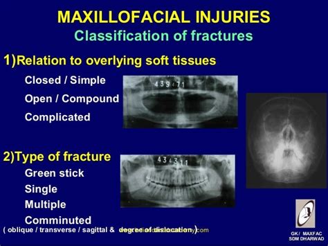 Maxillofacial injuries (2)