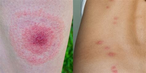 These Pictures Will Help You ID the Most Common Bug Bites This Summer