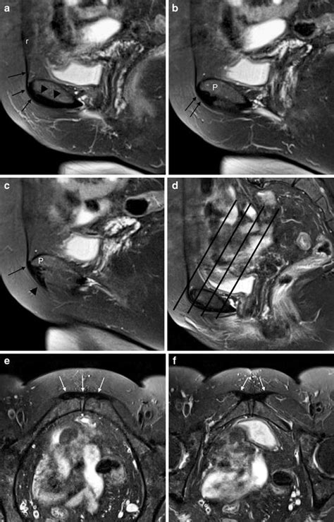 Imaging of Athletic Groin Pain | Musculoskeletal Key