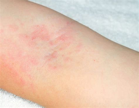 Rashes and Their Causes - Sacramento, CA | Emil A. Tanghetti, MD