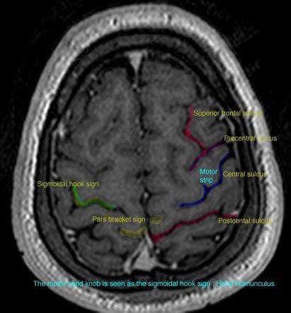 Central sulcus | Radiology Reference Article | Radiopaedia.org