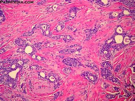 Histopathology images of Invasive ductal carcinoma, NOS by PathPedia ...