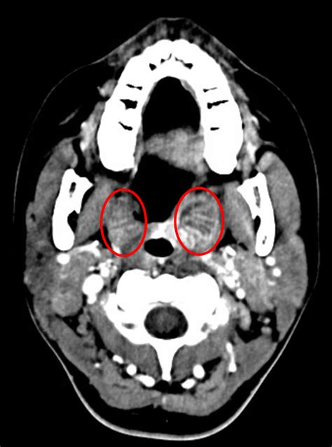 Palatine Tonsil Cyst