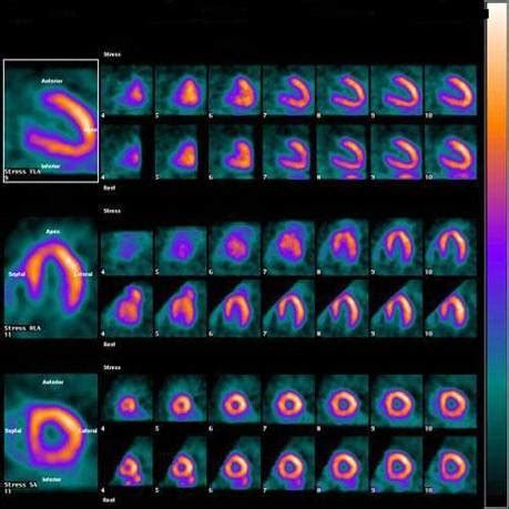 Spect Scan Heart