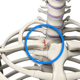 SC Joint Injury Houston, TX | SC Joint Reconstruction Houston, TX