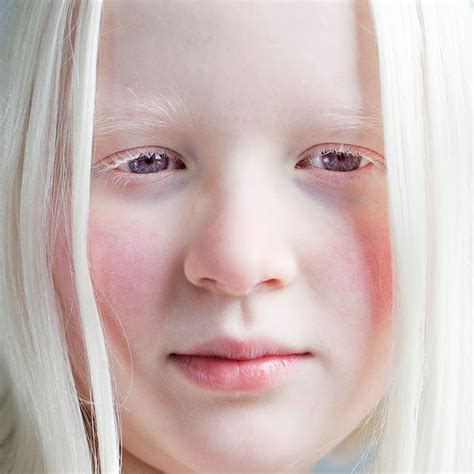 Albinism | Health articles for healthy living