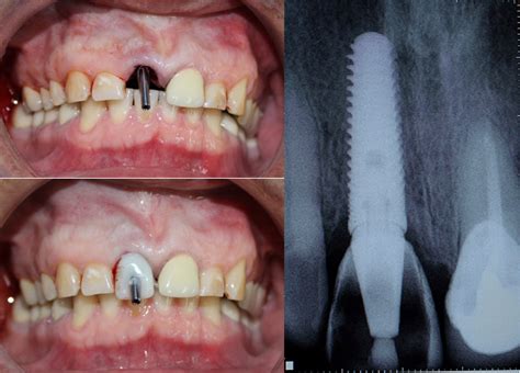 Implantes - Dental One