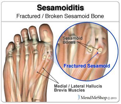 #Sesamoiditis can sometimes involve a break or fracture to your ...