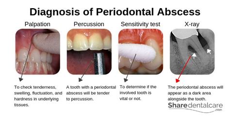 Periodontal Abscess Vs Periapical Abscess