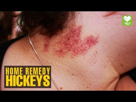 How To Treat Hickeys | Health Tips | Educational Video - YouTube