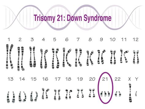 Trisomy 21 Down Syndrome Karyotype 8131474 Vector Art at Vecteezy