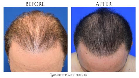 Platelet-Rich Plasma for Hair Loss | PRP Hair Restoration With Microneedling | Beverly Hills, CA ...