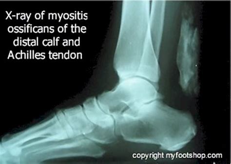 Myositis Ossificans | Causes and treatment options | MyFootShop.com